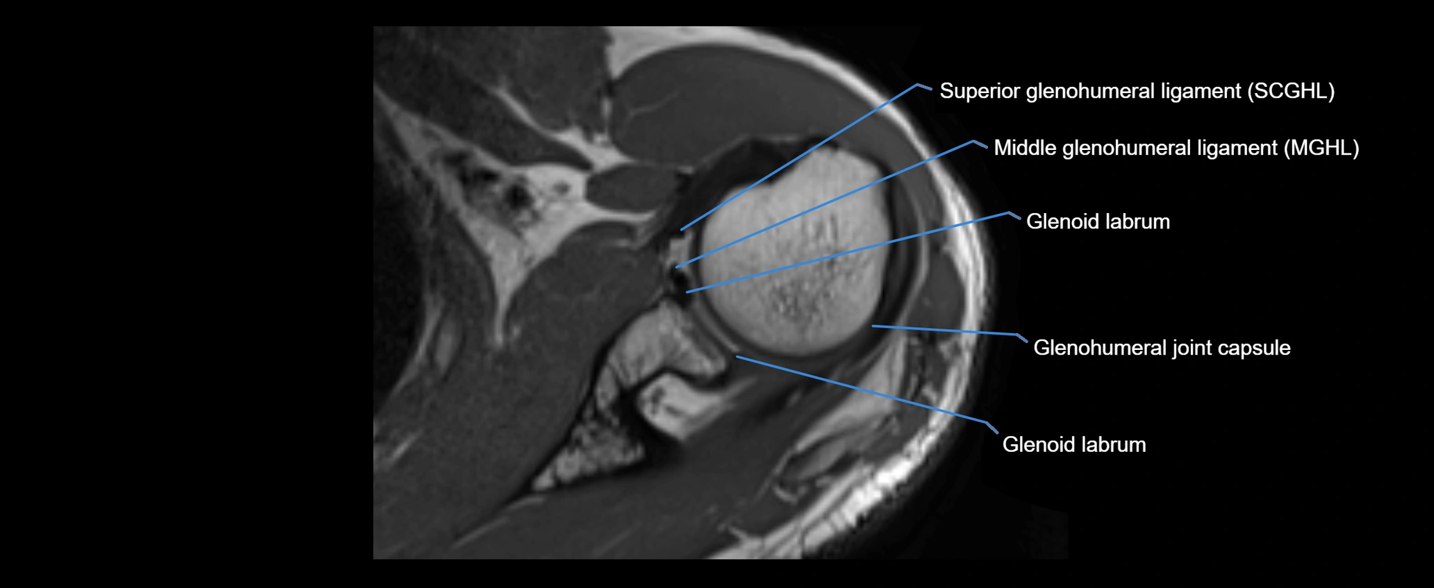 shoulder ligaments axial 3d 3t mri image-img-00005-00054.webp